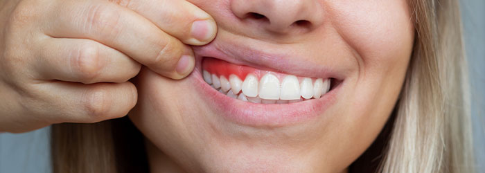 gingivite que faire